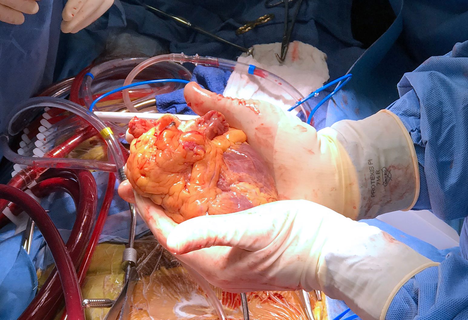 قلب‌های مصنوعی چاپی در بدن بیمار پس نمی‌زند / کوتاه شدن صف پیوند اعضا